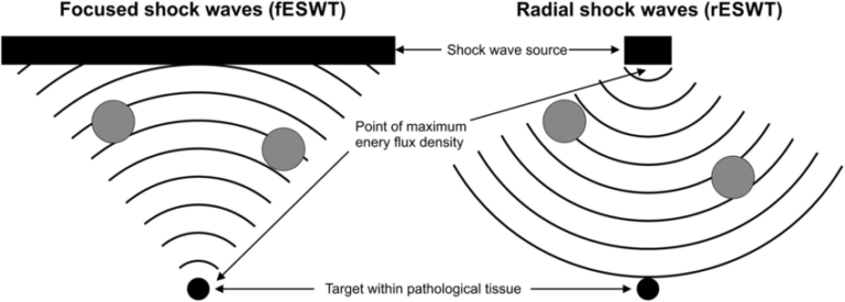 Working principle of focused and radial extracorporeal shock wave technology