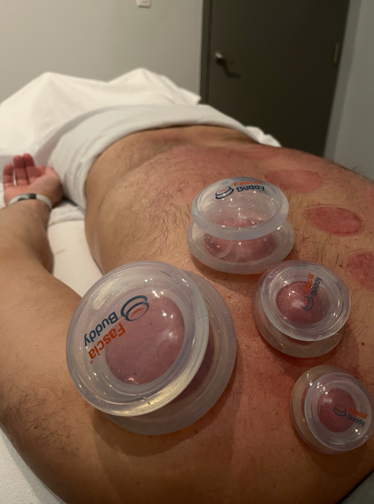 cupping therapy milton