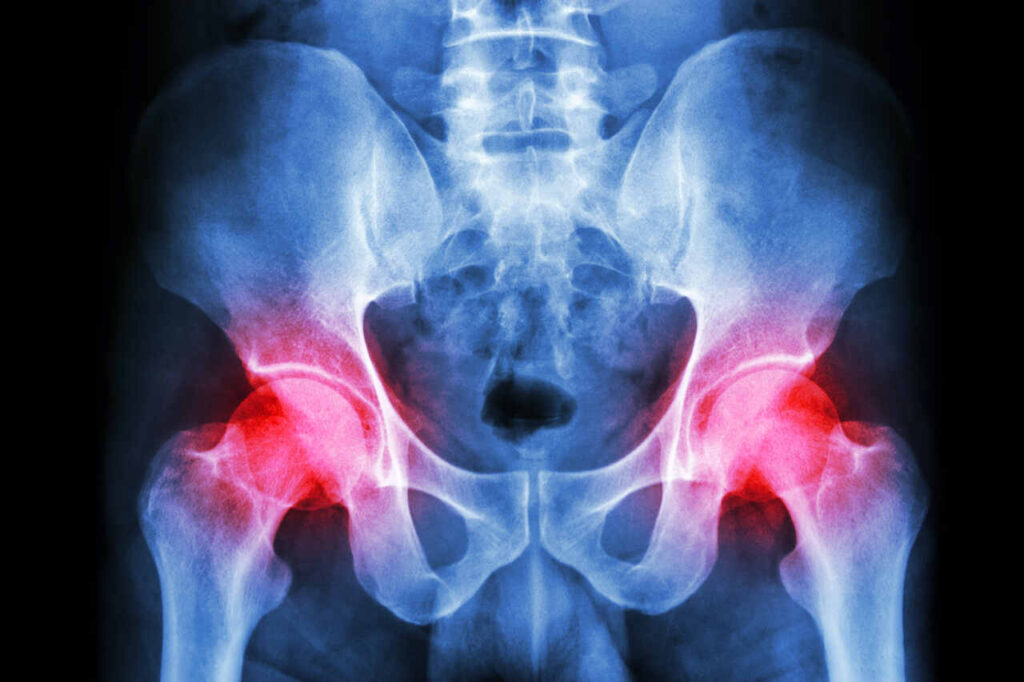 physiotherapy for arthritis